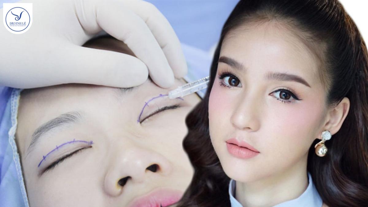 Bấm Mí Đa Điểm Châu Âu – Đôi mắt to tròn, cuốn hút tự nhiên.