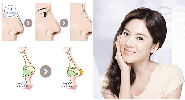 Sự khác biệt giữa nâng mũi cấu trúc và nâng mũi bán cấu trúc.