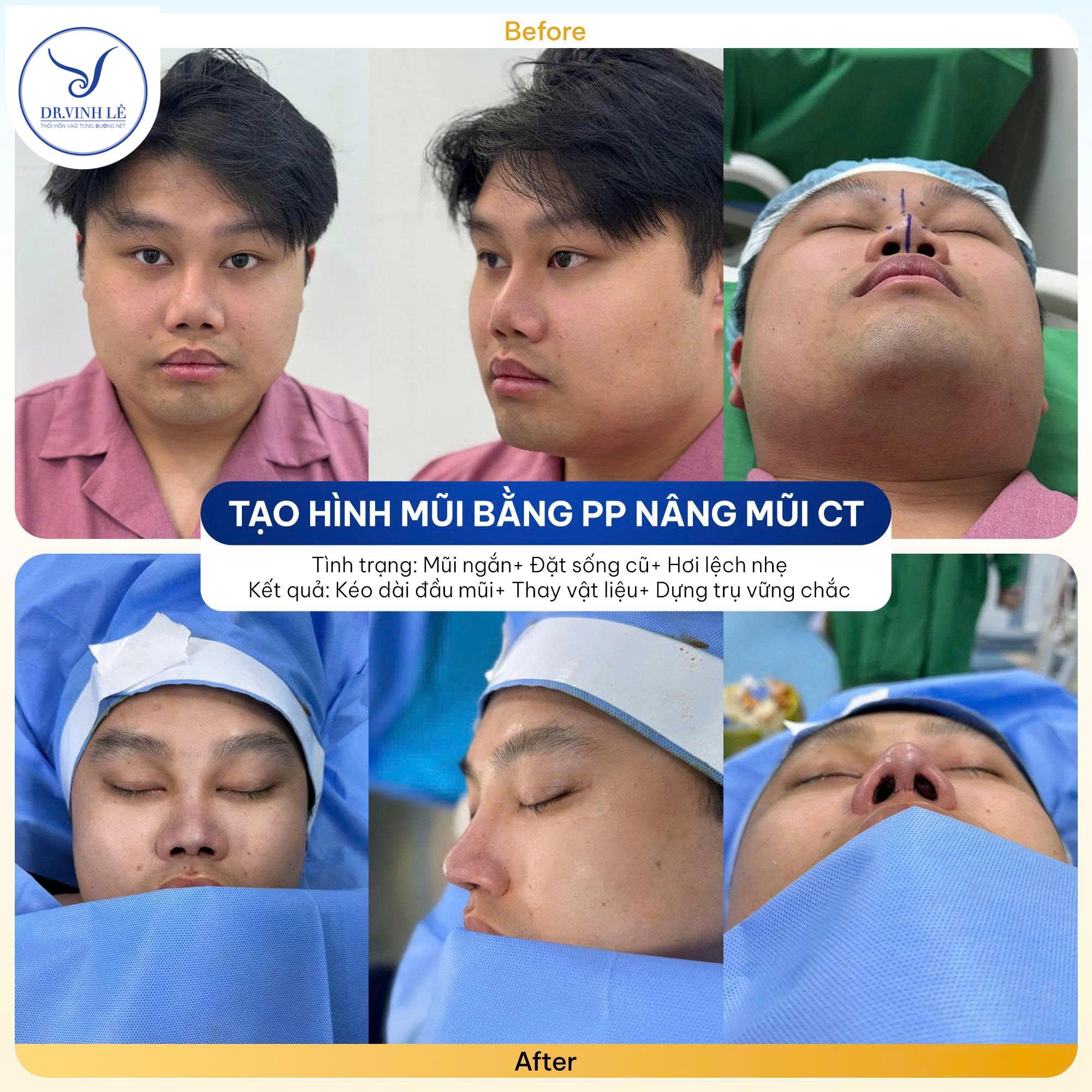 Khách hàng N.V.N tạo hình mũi bằng phương pháp nâng mũi cấu trúc.