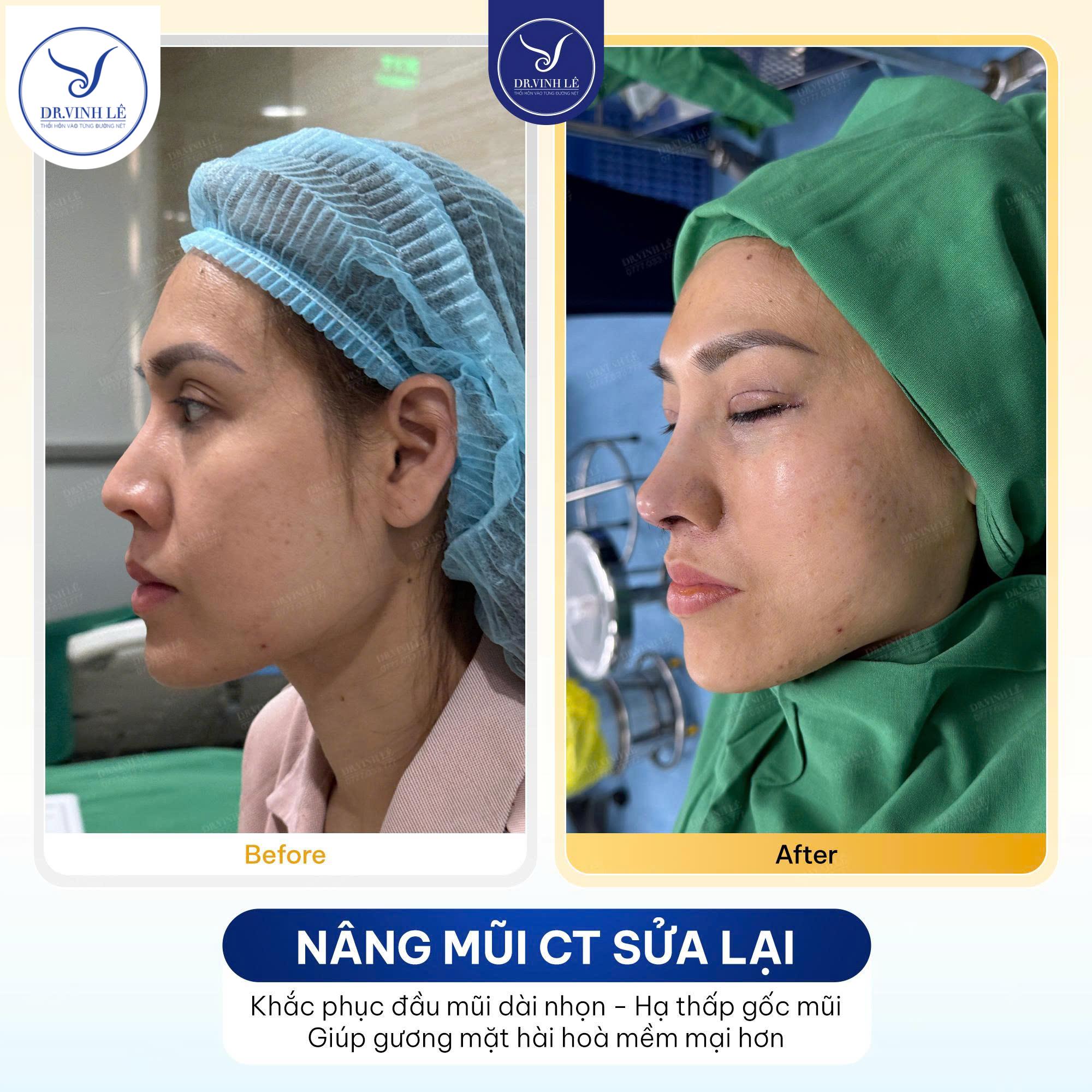 Hình ảnh Before/After khách hàng nâng mũi bọc sụn tai tại Dr. Vinh Lê.