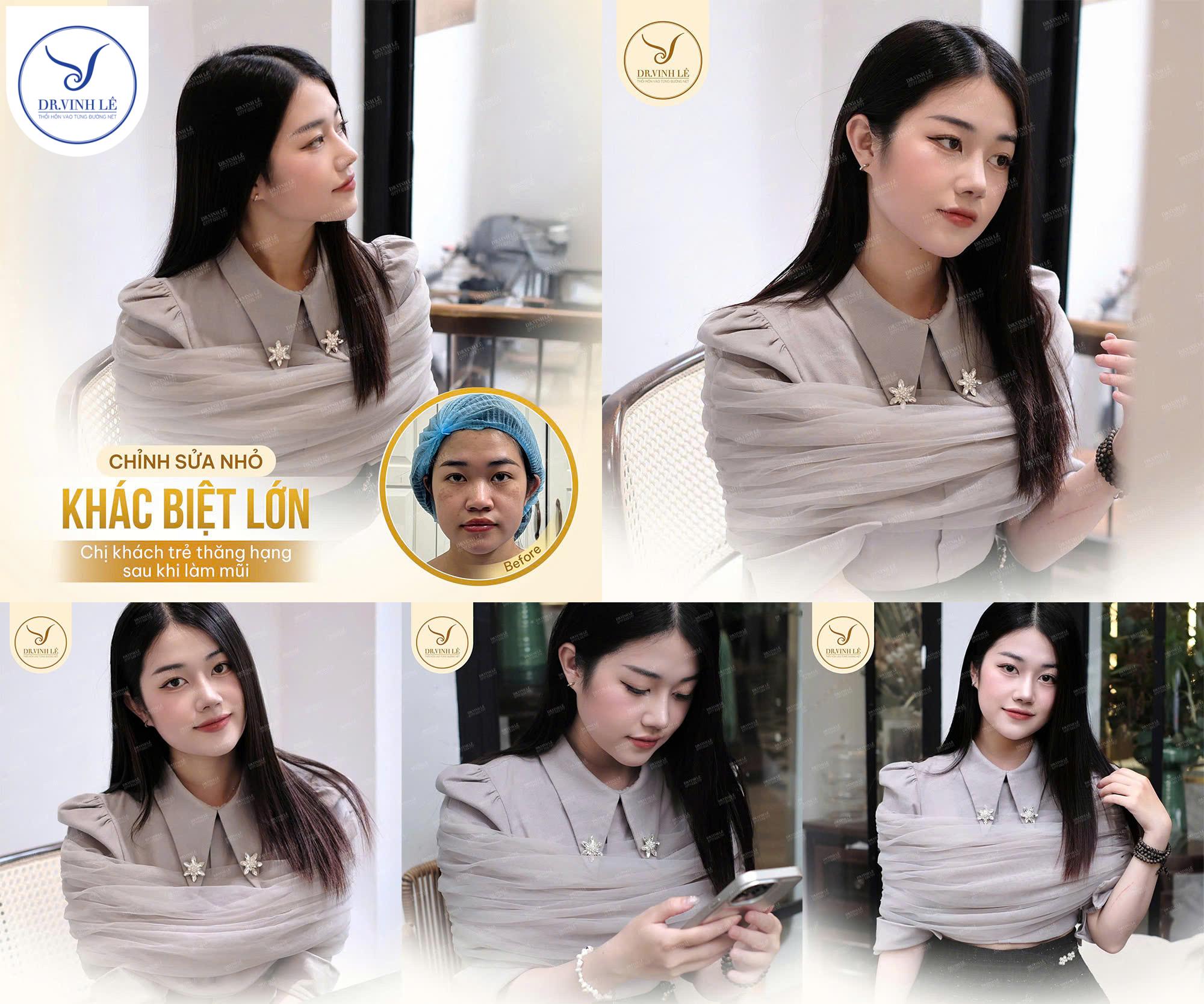 Khách hàng tuổi teen thăng hạng nhan sắc sau nâng mũi bọc sụn tai tại bác sĩ Lê Hoàng Vinh.
