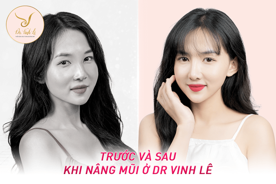 Trước và sau khi nâng mũi ở Dr Vinh Lê