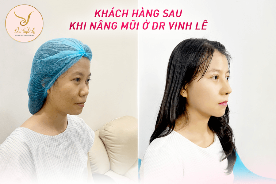 Hình ảnh trước và sau của khách hàng khi nâng mũi ở Dr Vinh Lê