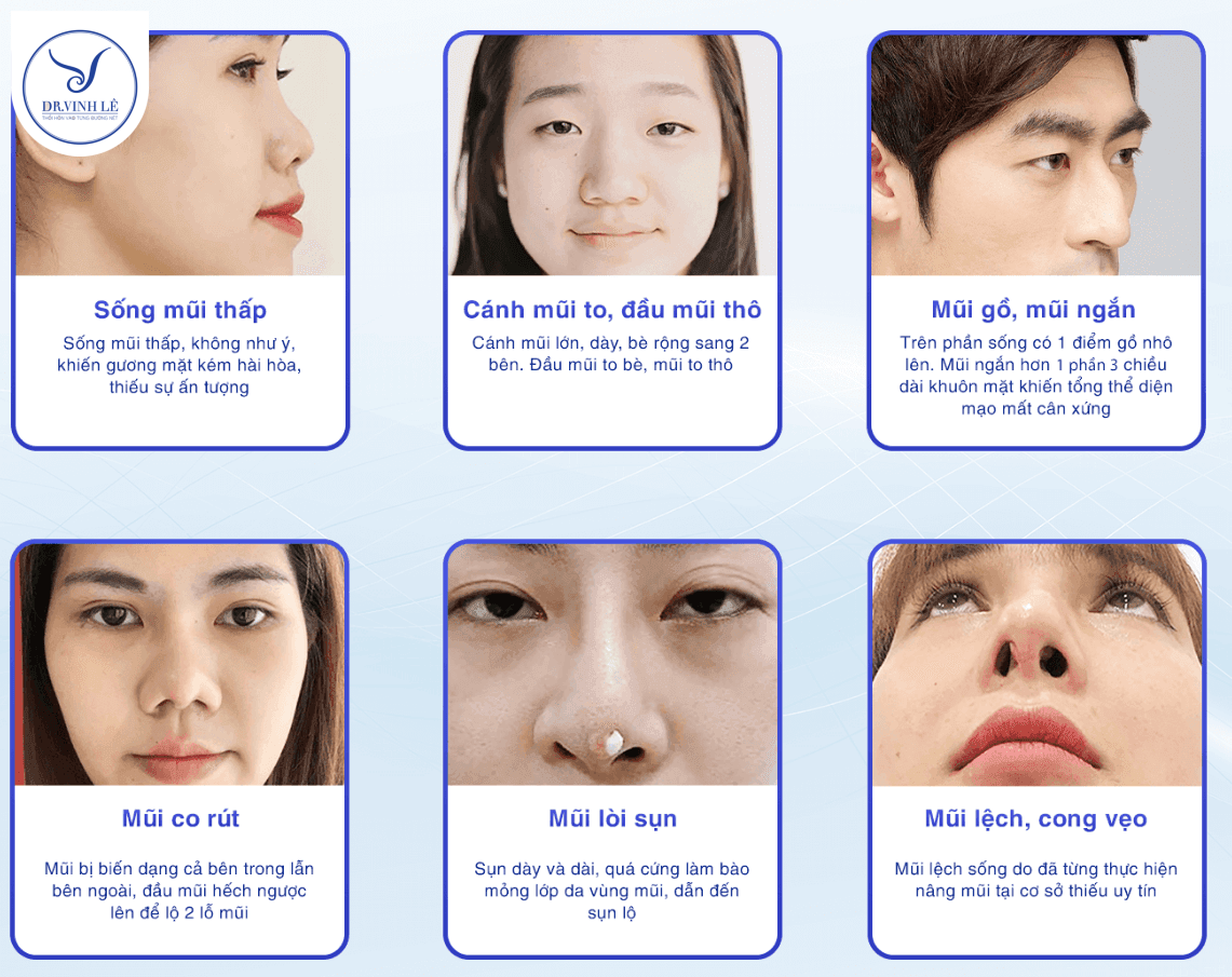 Các trường hợp nên thực hiện nâng mũi cấu trúc Surgiform.
