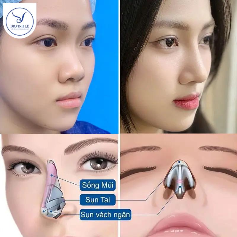 Các tiêu chí so sánh giữa nâng mũi cấu trúc và nâng mũi bán cấu trúc.