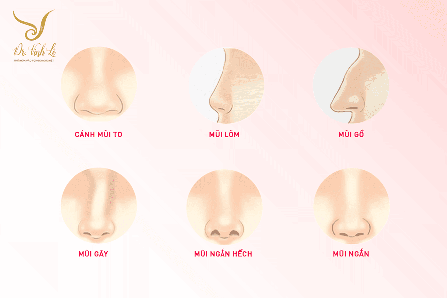 Mũi cấu trúc Surgiform-Dành cho mọi dáng mũi khuyết điểm: mũi tẹt, mũi gồ, mũi hếch, mũi to
