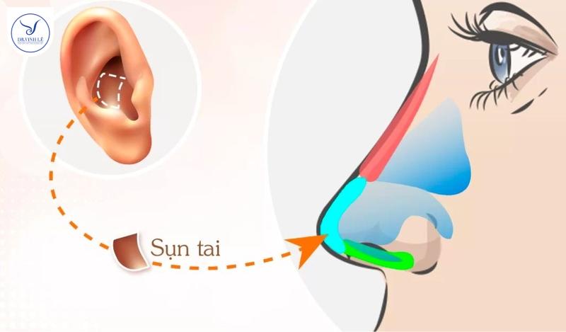 Nâng mũi bọc sụn tai có vĩnh viễn không, có an toàn không?