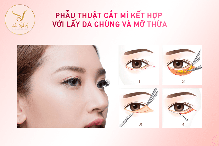 Phẫu thuật cắt mí kết hợp với lấy da chùng và mỡ thừa