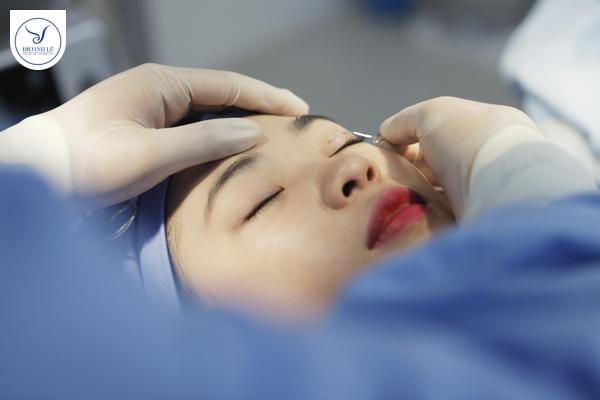 Phẫu thuật bấm mí đa điểm châu âu thực tế tại Thẩm mỹ viện Dr Vinh Lê.