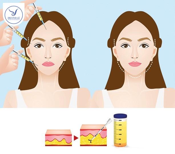 Phương pháp cấy mỡ mặt bằng mỡ tự thân.