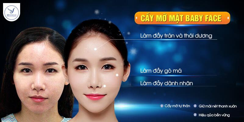 Phương pháp cấy mỡ mặt Baby Face.