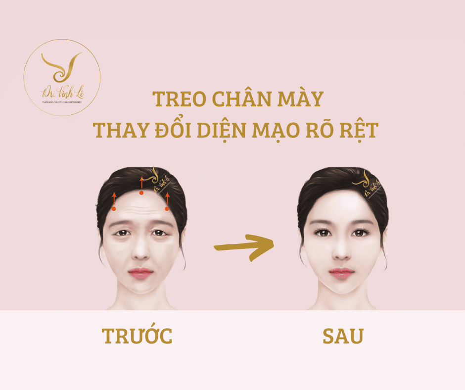 Read more about the article Treo Chân Mày – Thay Đổi Diện Mạo Rõ Rệt Ngay Sau Làm