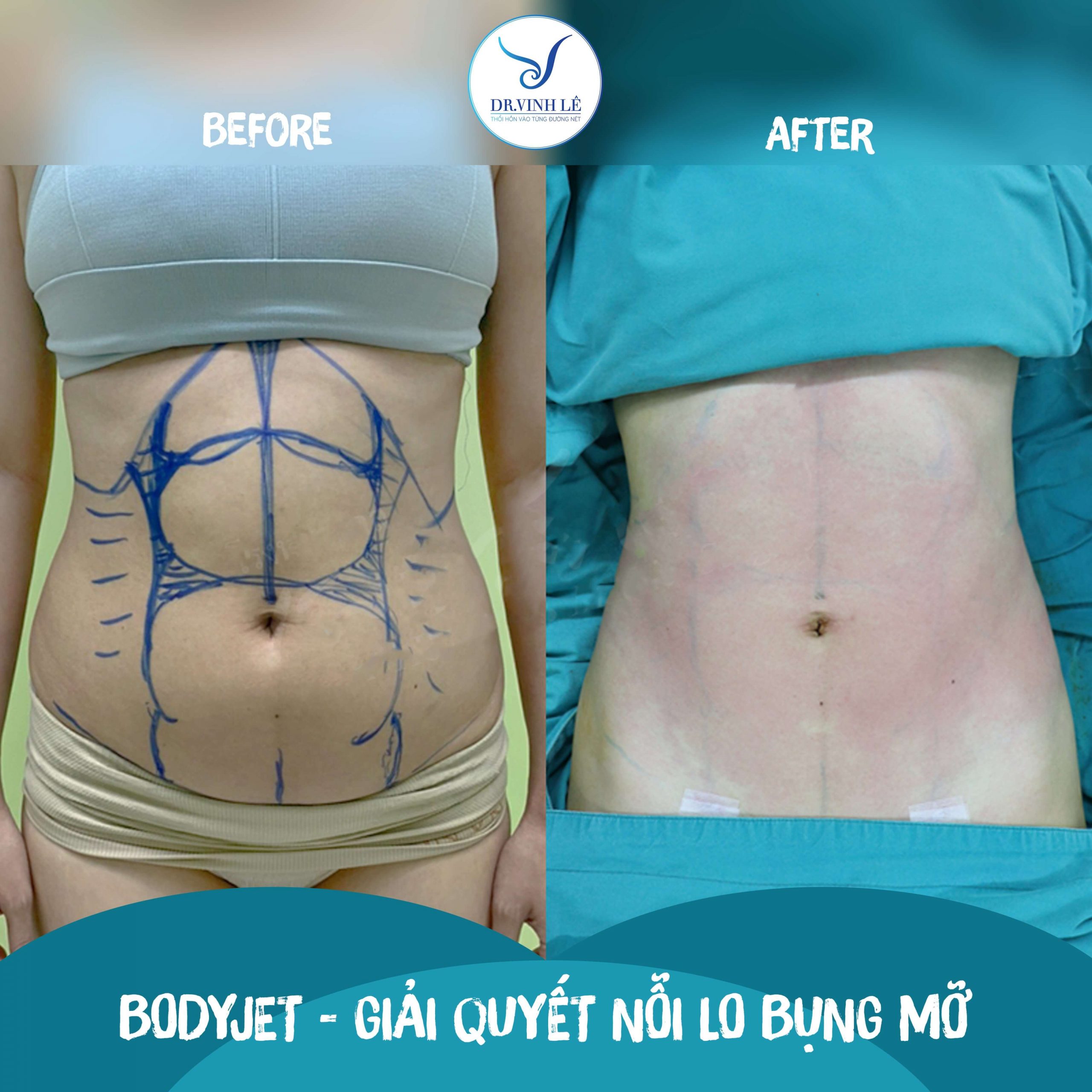 Hình ảnh khách hàng trước và sau Hút mỡ bụng BodyJet bởi Dr Vinh Lê