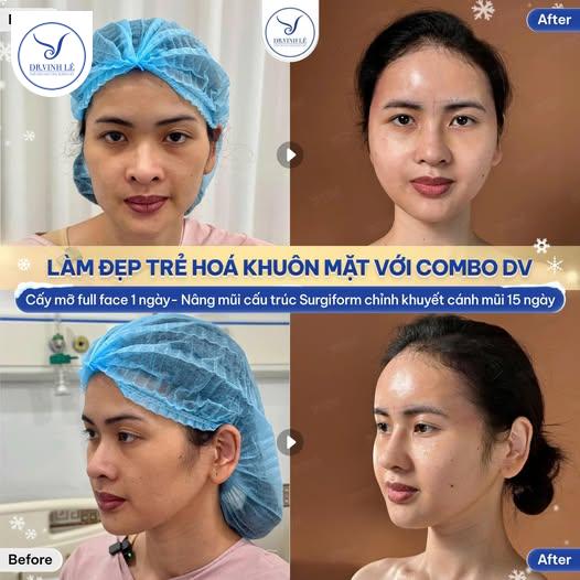 Khách hàng thực hiện combo: cấy mỡ full face + nâng mũi cấu trúc Surgiform.