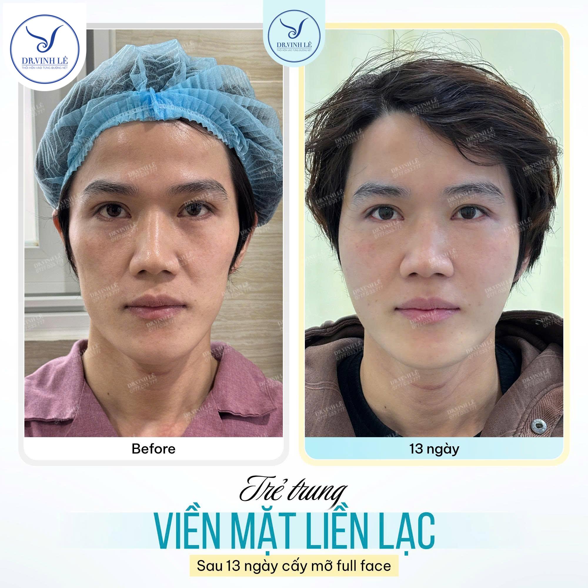 Khách hàng sau 13 ngày cấy mỡ full face.