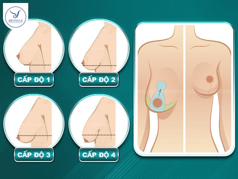 Những cấp độ ngực sa trễ.