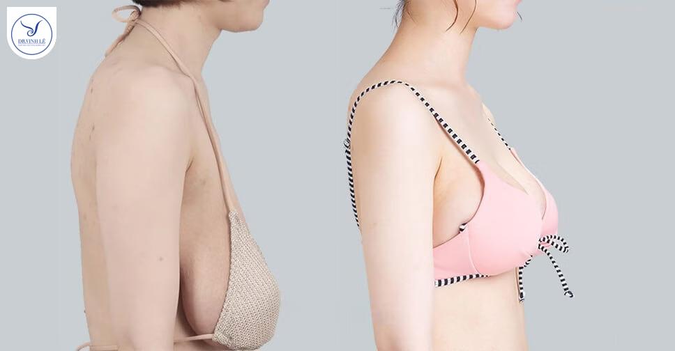 Treo sa trễ không đặt túi có phải lựa chọn tốt không?