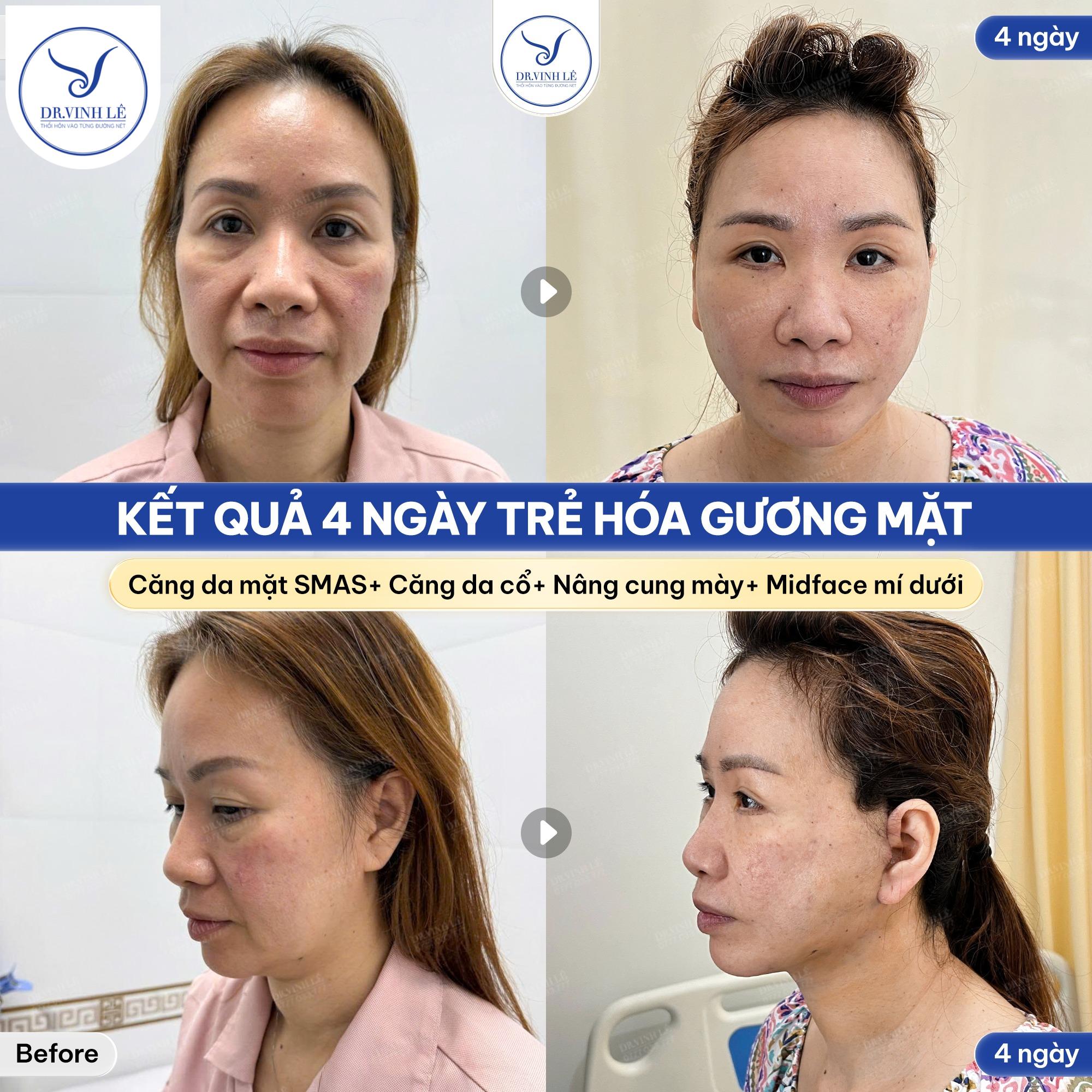 Bác sĩ Lê Hoàng Vinh – Nổi tiếng với kỹ thuật Căng da mặt Smas & Trẻ hóa gương mặt