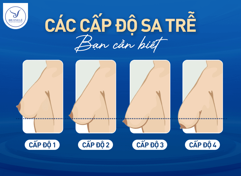 Có bao nhiêu cấp độ ngực sa trễ?