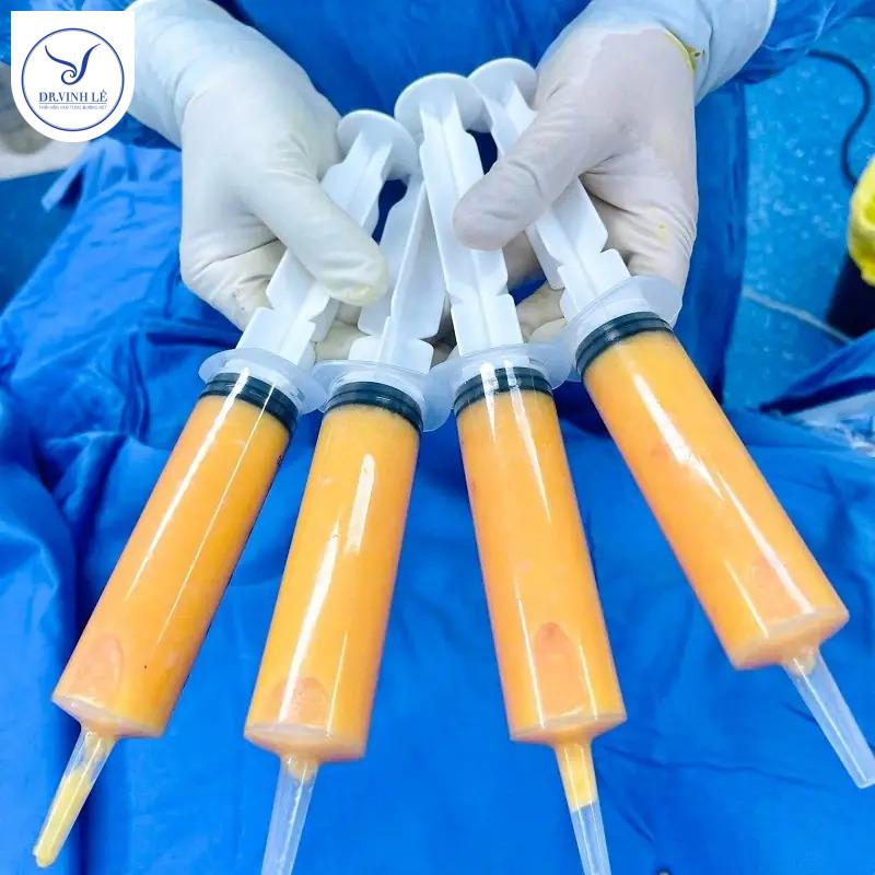 Phương pháp cấy mỡ bằng mỡ tự thân.