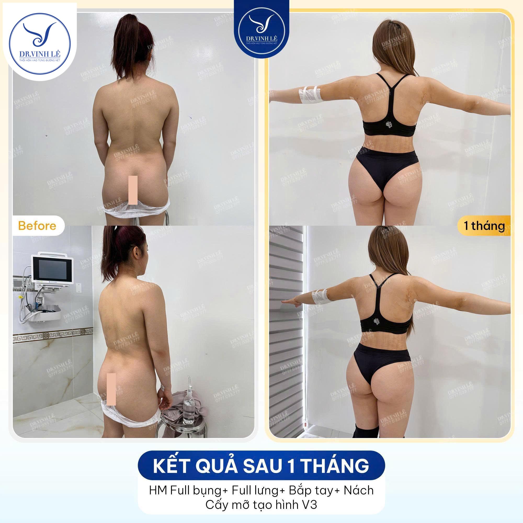 Cấy mỡ mông giữ được bao lâu?