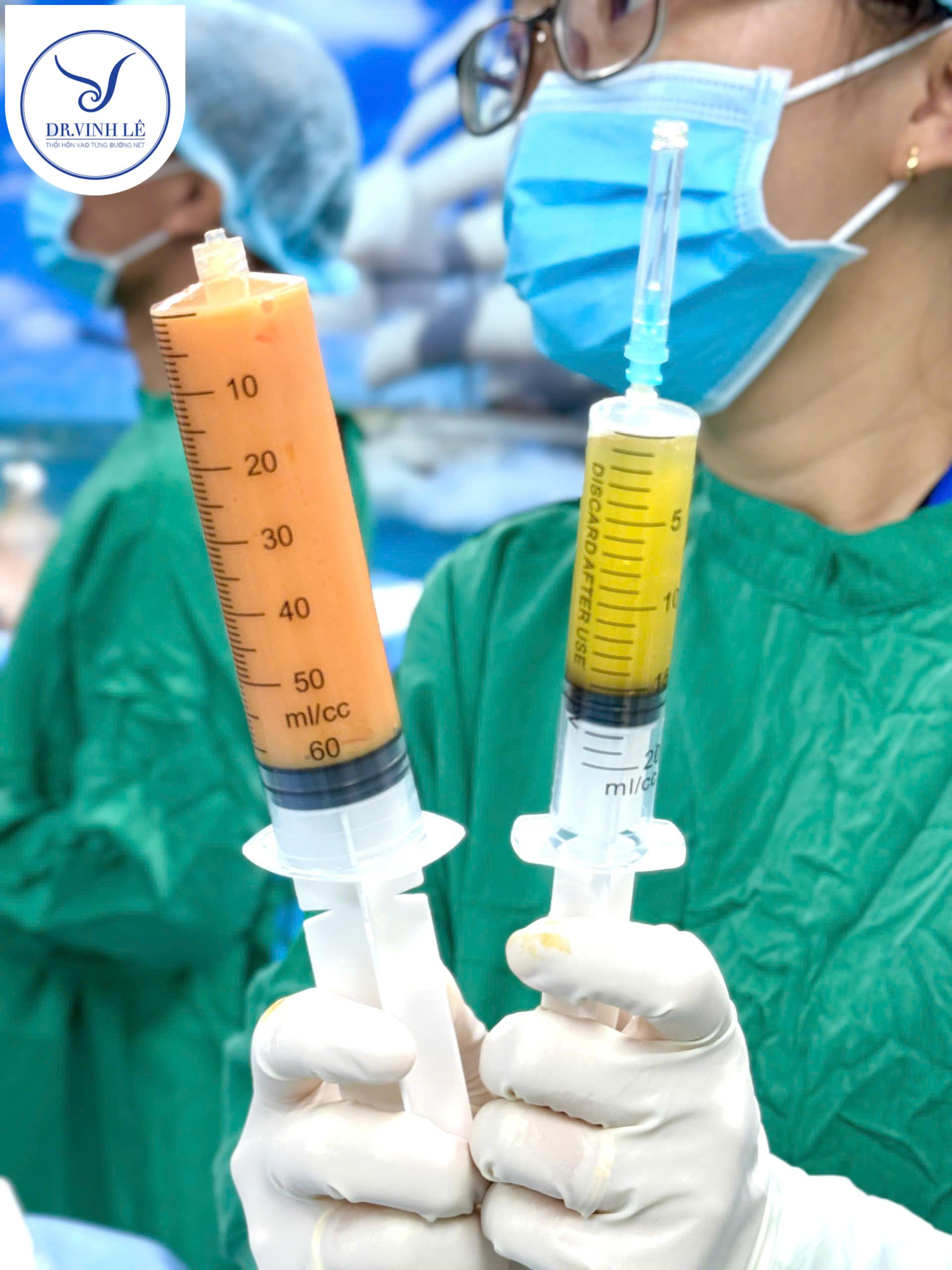 Cấy mỡ tự thân: giải pháp vàng để có thân hình hoàn hảo