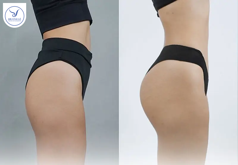 Cấy mỡ mông là gì? Giải đáp chi tiết