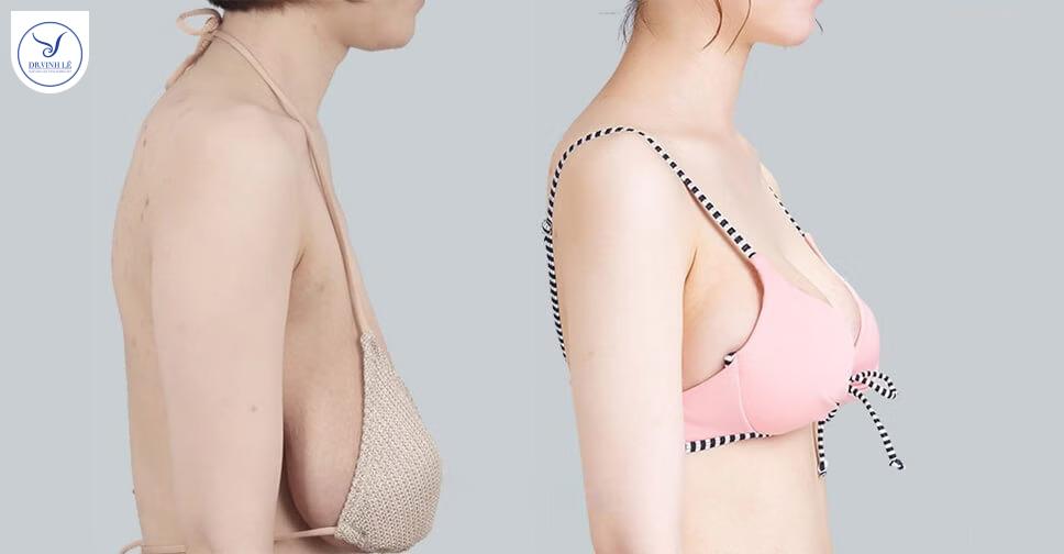 Treo Sa Trễ Là Phương Pháp Điều Trị Ngực Sa Cho Chị Em Sau Sinh