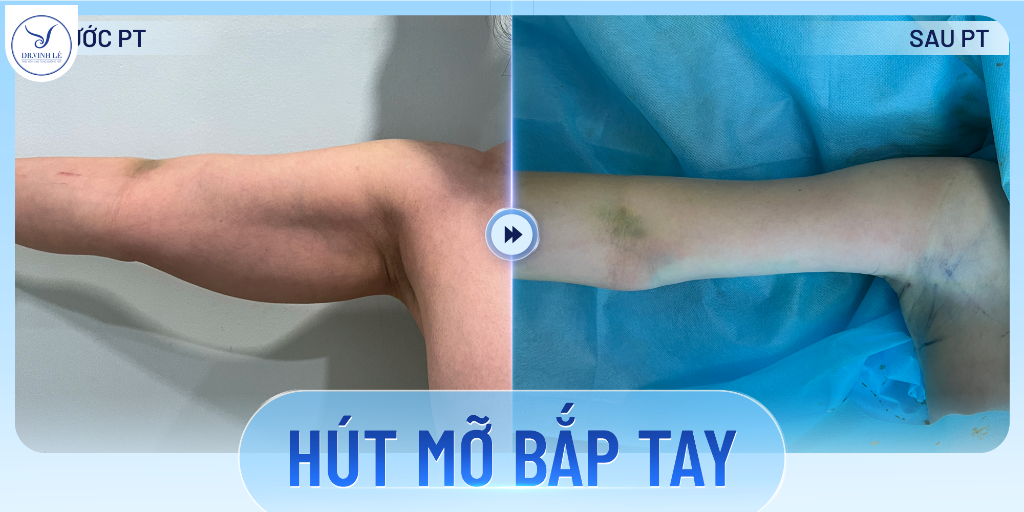 Hút mỡ bắp tay có an toàn không? Rủi ro như thế nào?