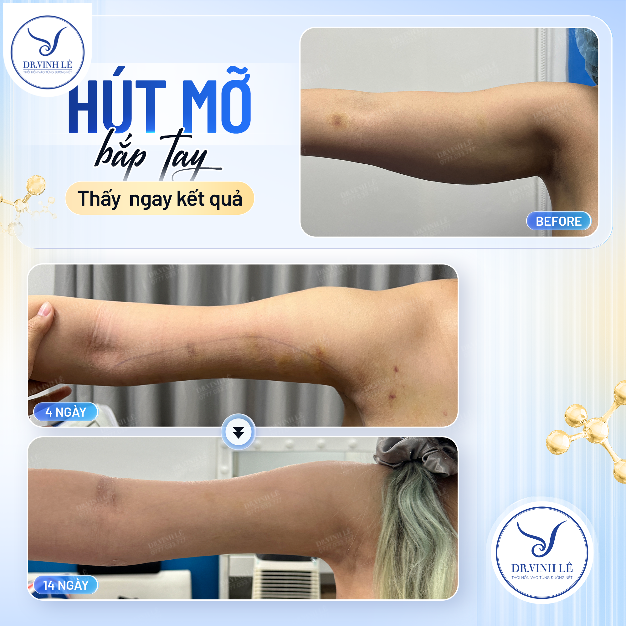 Hút mỡ bắp tay có đau không?