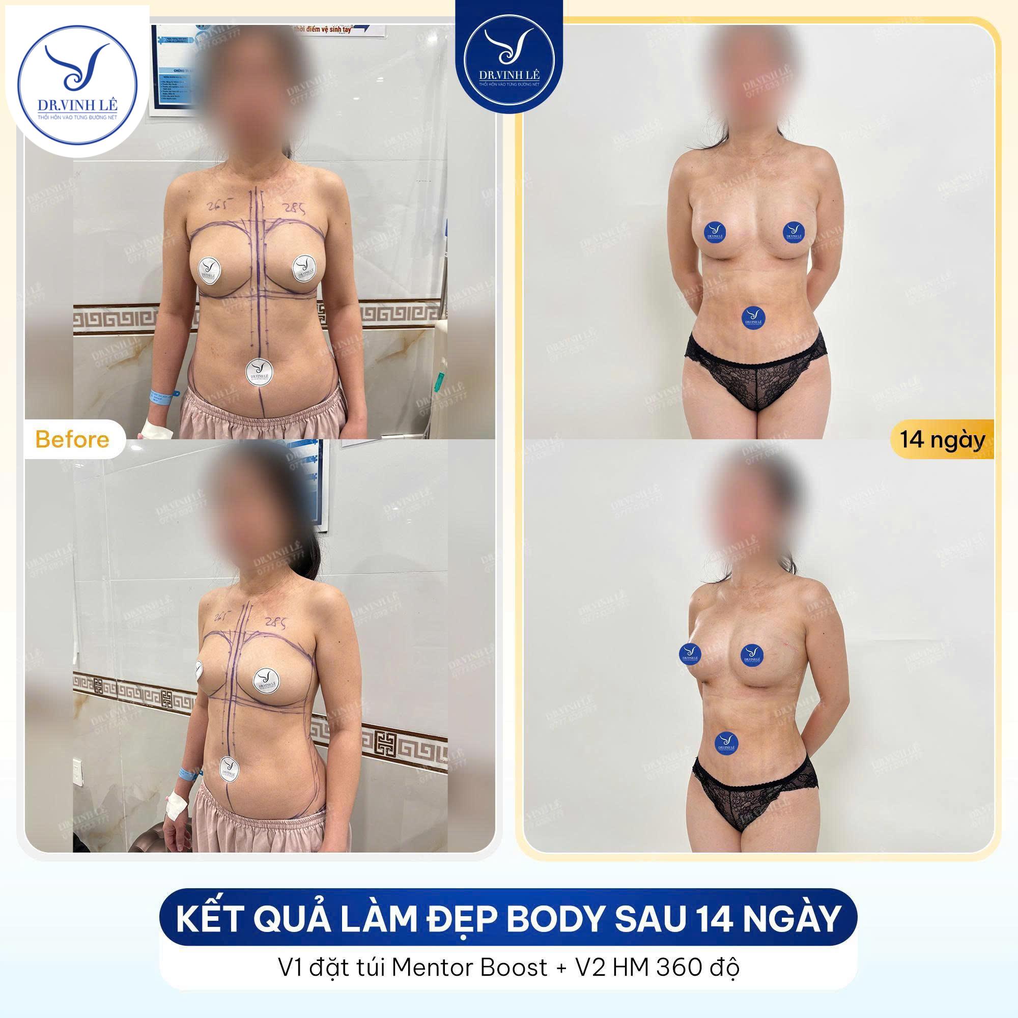 Kết Quả Sau Khi Nâng Ngực Bằng Túi Mentor Boost Từ Bàn Tay Bác Sĩ Lê Hoàng Vinh