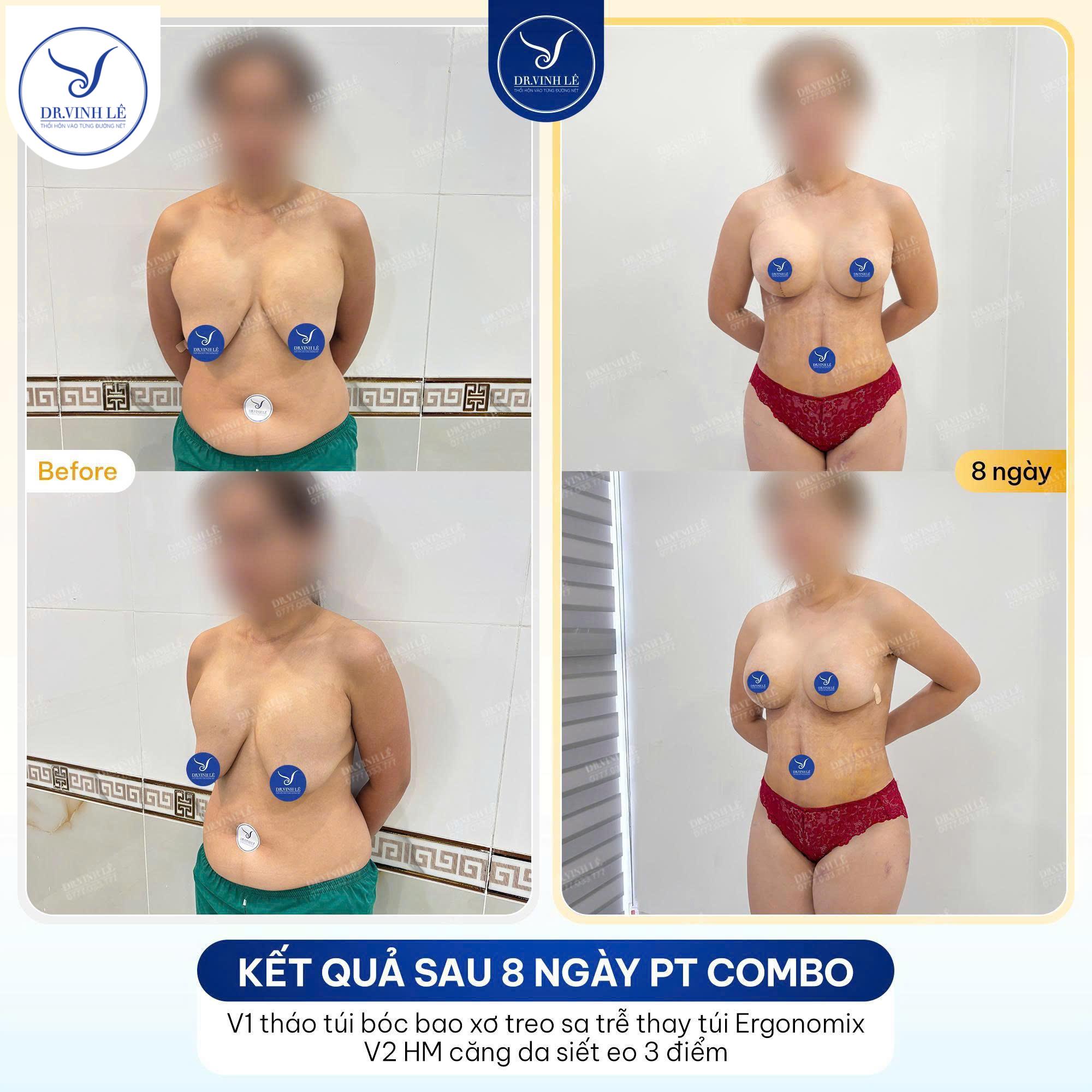 Ngực Sa Trễ Là Gì? Có Bao Nhiêu Cấp Độ?