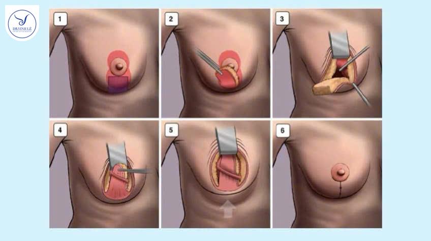Các phương pháp treo ngực sa trễ hiện nay