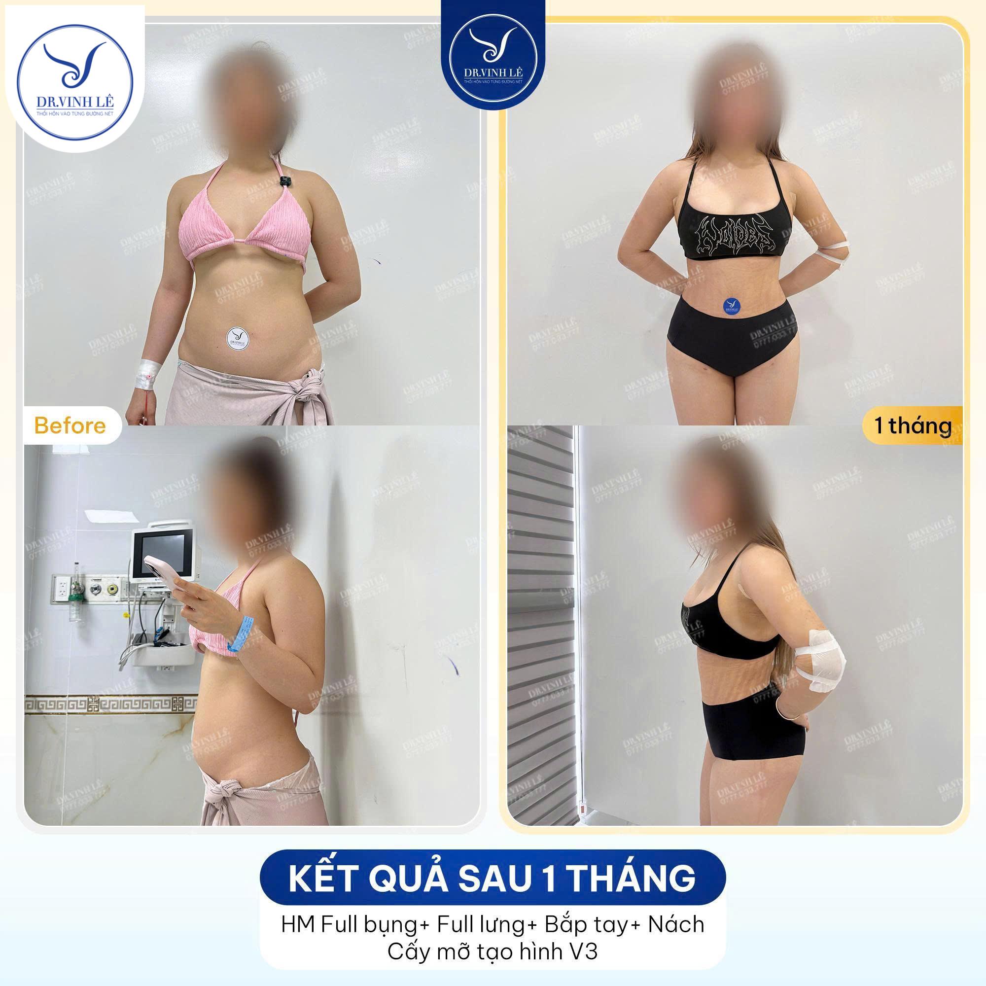 Lợi ích và rủi ro tiềm ẩn khi cấy mỡ mông