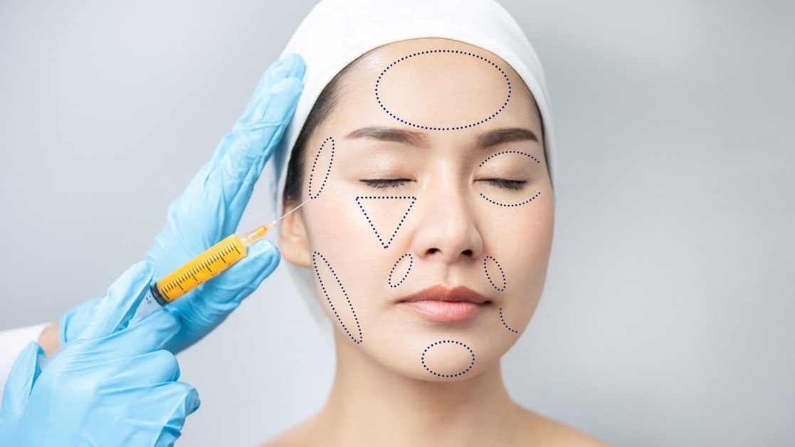 Cấy mỡ tự thân lên mặt duy trì được bao lâu?