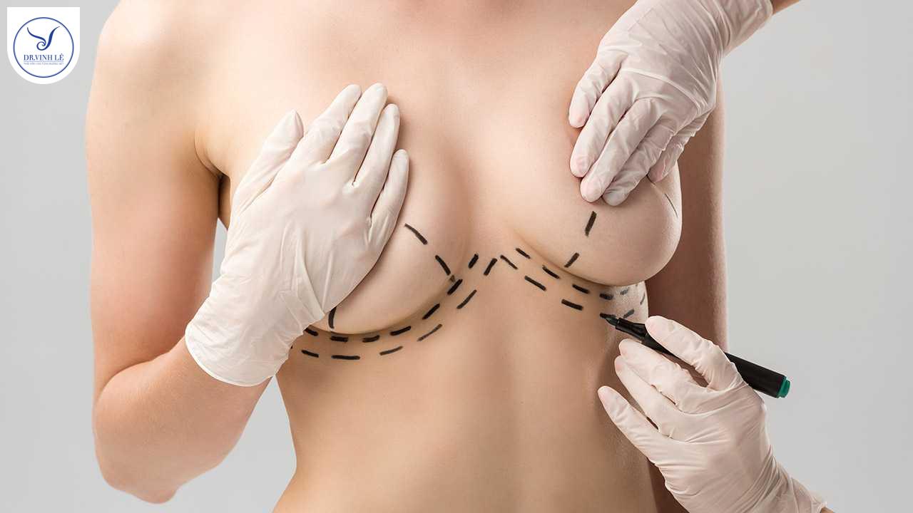 Ngực sa trễ là gì?