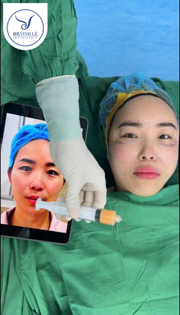 Tiêm mỡ tự thân là phương pháp thẩm mỹ an toàn & hiệu quả tự nhiên