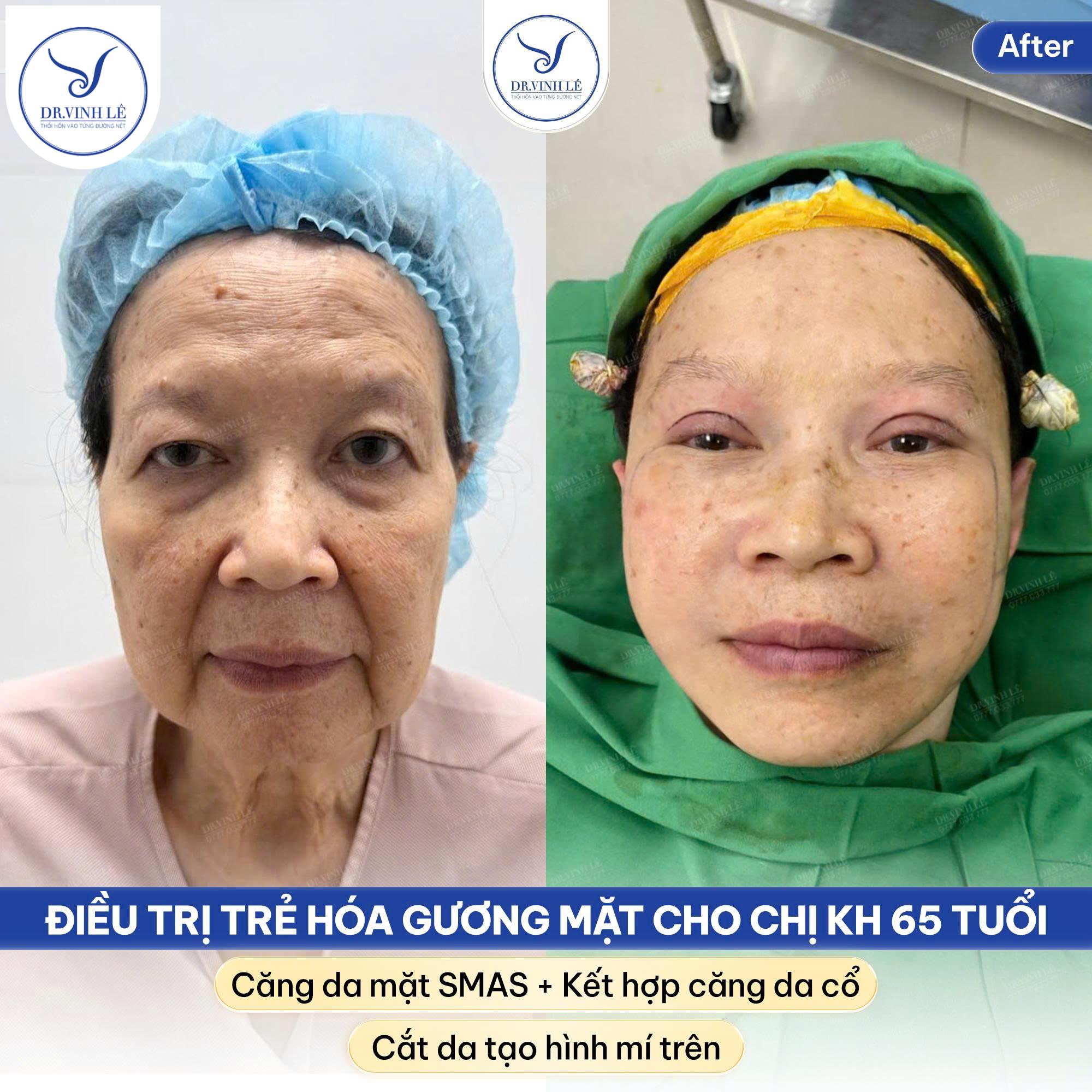 Điều trị trẻ hoá khuôn mặt bằng các phương pháp Căng da mặt SMAS