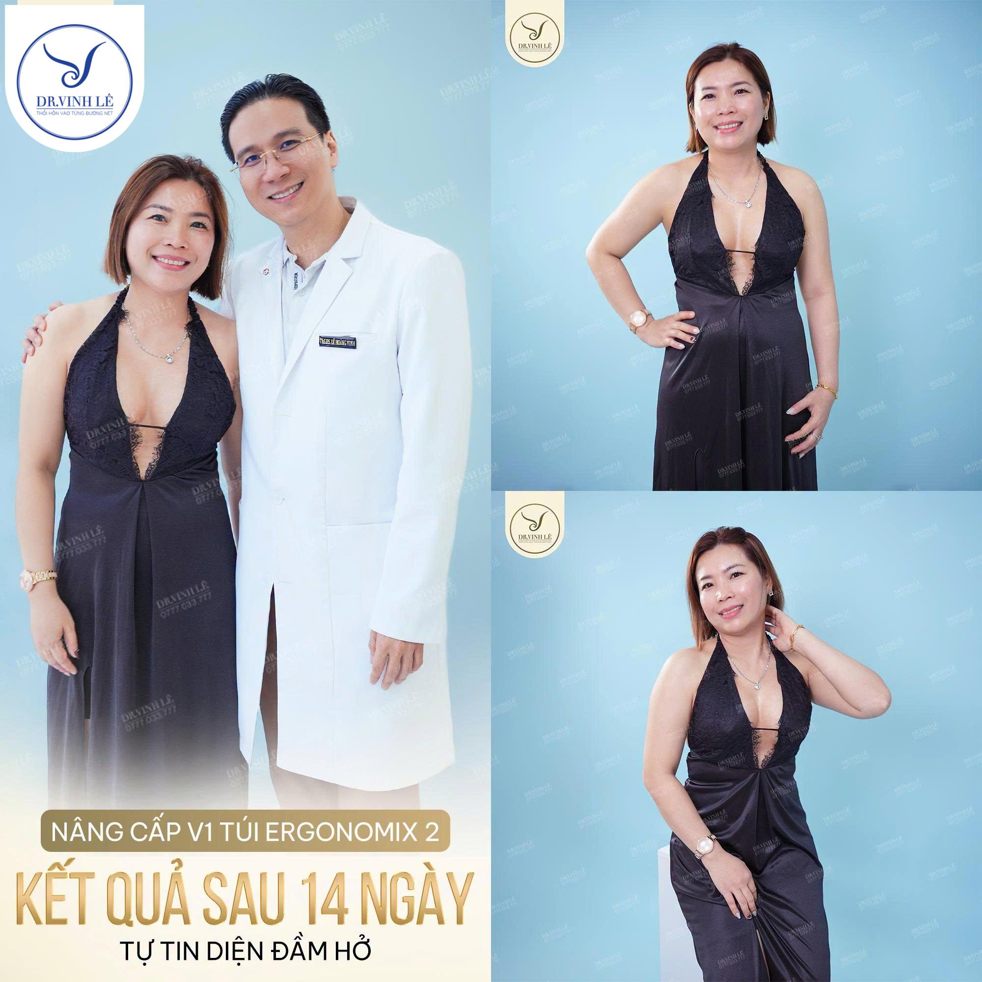 Kết quả 14 ngày sau khi nâng cấp V1 túi Ergonomix 2 của chị khách hàng.