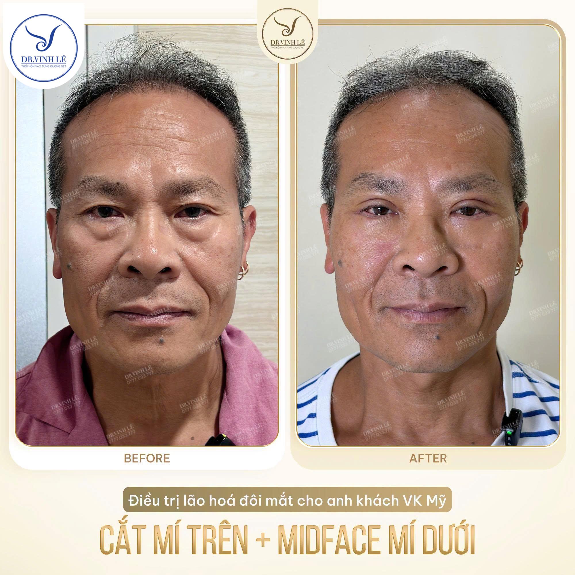 Điều trị lão hoá cho anh khách VK Mỹ với combo, loại bỏ da chùng mí trên và midface mí dưới.