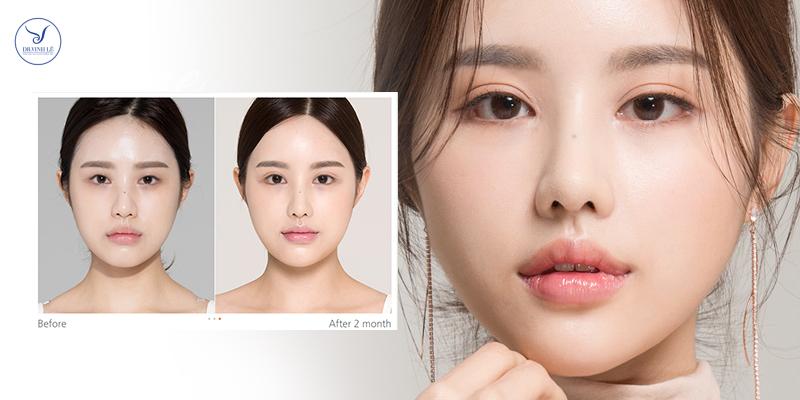 Cắt mí Hàn Quốc là phương pháp gì?