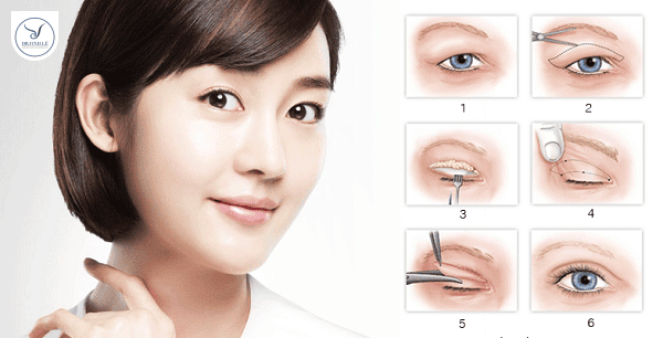 Cắt Mí Hàn Quốc – Phương pháp tạo đôi mắt tự nhiên, to tròn & bền lâu.