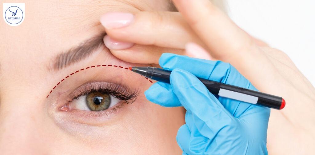 Dấu hiệu cho thấy bạn đang gặp tình trạng mí hỏng.